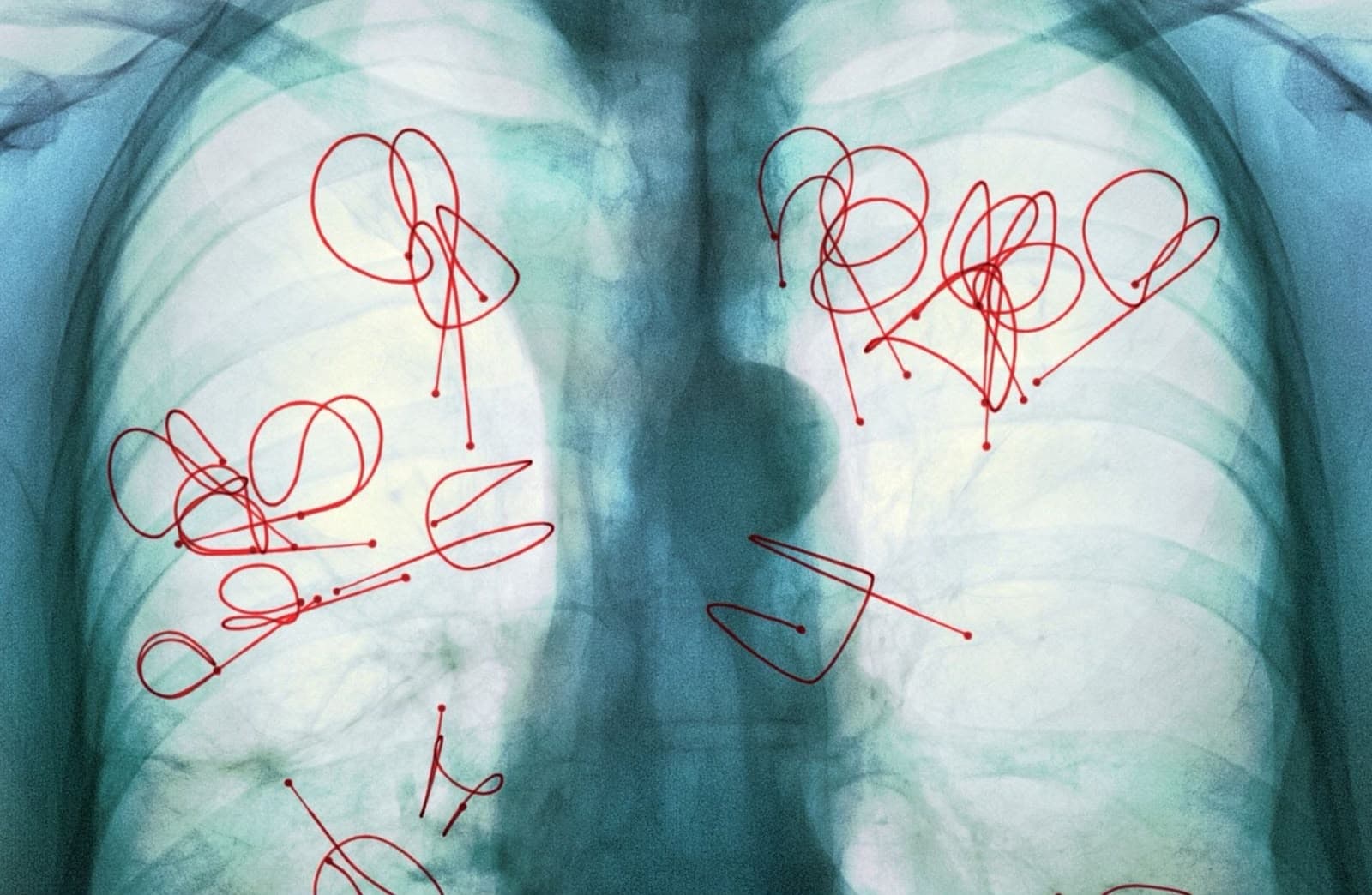 Endobronchiale Spiralenbehandlung
