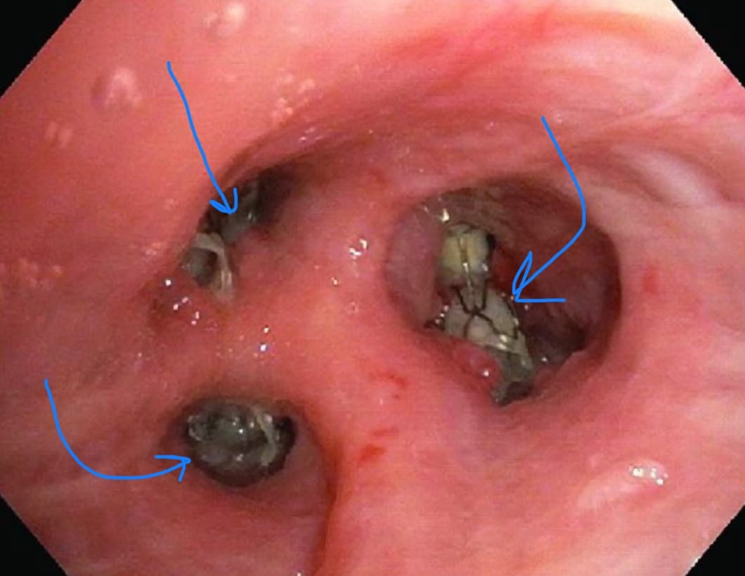 Endobronchiale Ventiltherapie