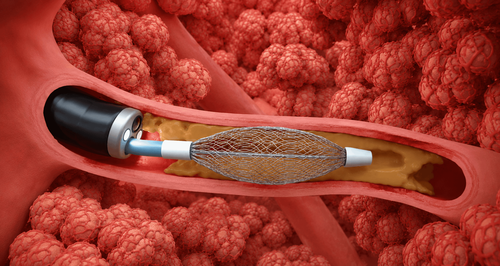 Bronchiale Rheoplastie (PEF)